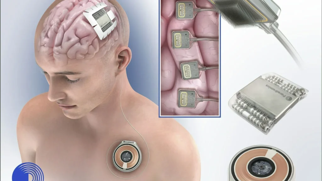 Implant cerebral de la Paradromics